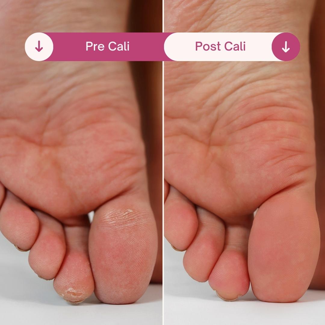 Cali Electric Callus Remover